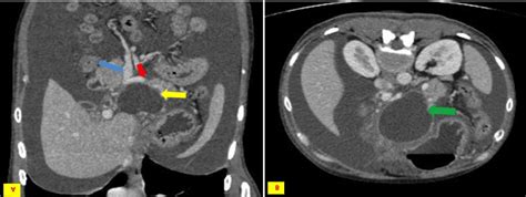 Contrast Enhanced Computed Tomography Scan Of Abdomen Pancreatic