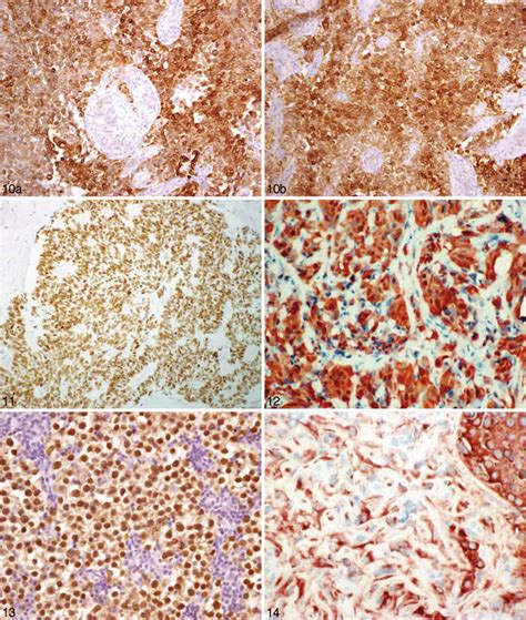 Treatment options associated with epithelioid mesothelioma epithelioid mesothelioma possesses a better prognosis when compared to biphasic and sarcomatoid subtypes. Photomicrograph of epithelioid mesothelioma with nuclear ...