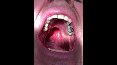 Soft Palate Cancer Denture Obturator Dr Veyvoda And Michael Mimg