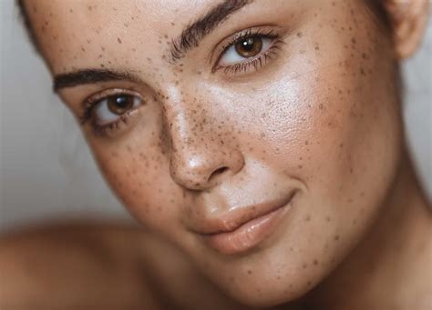 Areas Of Concern Hyperpigmentation And How To Treat It — M Spa At The