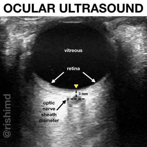Ocular Ultrasound For Increased Intracranial Pressure Rkmd