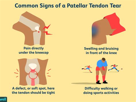 Tendons attach the knee muscles to the bone. 30 Refer To The Diagram To The Right. Which Of The ...