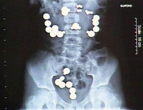 People Swallowed Weird Things And This Is What Doctors Found In Their Bodies Thatviralfeed