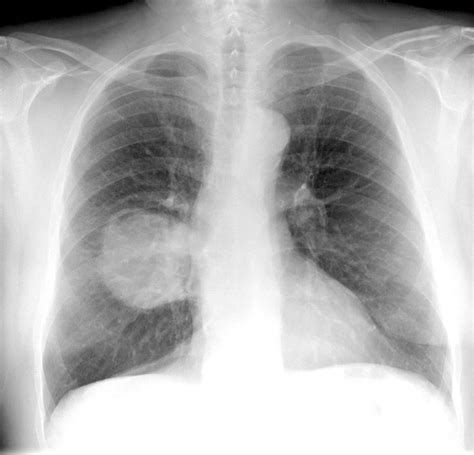 lung cancer x rays pix hot sex picture
