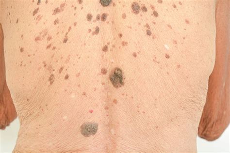 Skin Tags And Warts Dr Vindy Ghura Dermatologist Manchester