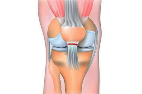 Quadriceps Tendon Rupture Repair Knee Surgery Specialist Dr Satish