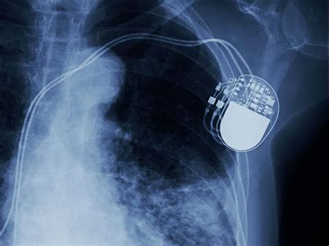 Pacemakers And Defibrillators In Singapore Cadence Heart Centre