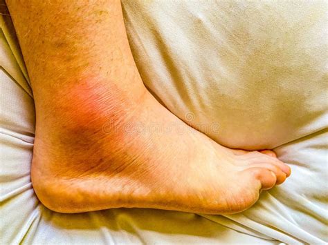 Red Swollen Ankle On Foot Due To Acute Gout Stock Photo Image Of Caucasian Inflammed
