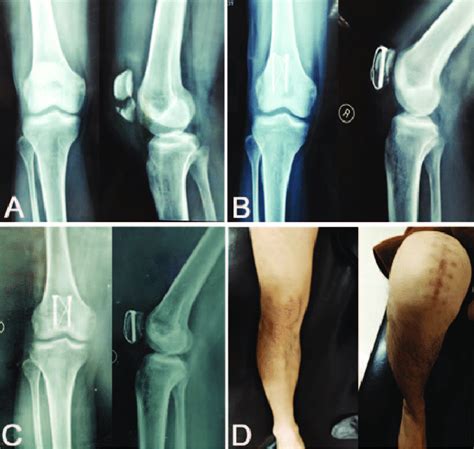 A 48 Year Old Male Patient With Right Transverse Patella Fracture