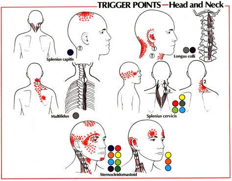 What Is A Proper Diagnostic Block Headache Work Up Regenexx