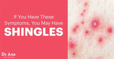 Shingles Symptoms Common Risk Factors And Causes Dr Axe