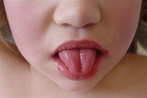Scarlet Fever Cases Surge To More Than Twice Seasonal Average Gponline