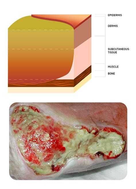 Wound Types Pressure Injuries And Ulcerations Ausmed