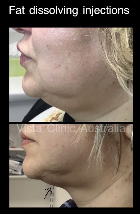 Double Chin Fat Dissolving Vista Clinic Melbourne Australia
