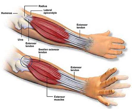 Figure 4 from calcific tendinits at the origin of common extensor these pictures of this page are about:extensor tendons forearm. Forearm Pain: A New Treatment For An Old Problem - DRUM ...