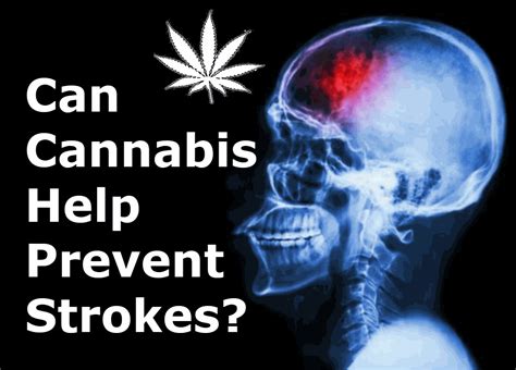 Can Cannabis Help Prevent Strokes?