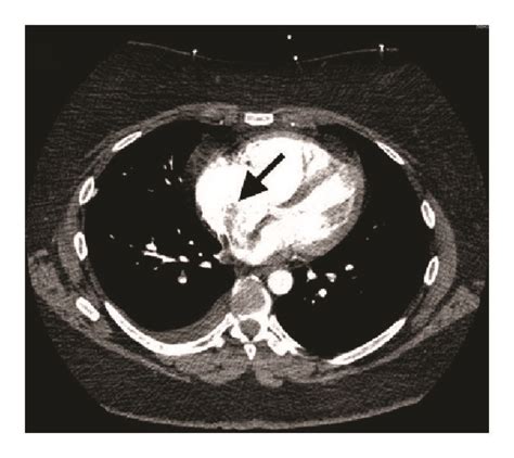 Ctpa Showing Saddle Pe A Intracardiac Thrombus Extending From Ra To