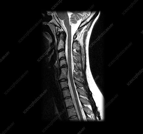 Mri Of Cervical Spine Stock Image M1200161 Science Photo Library