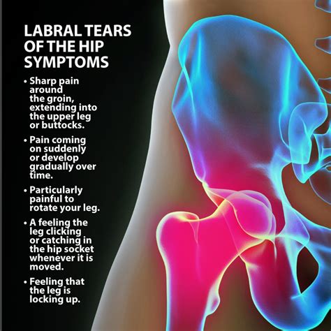 Hip Labral Tears Florida Orthopaedic Institute