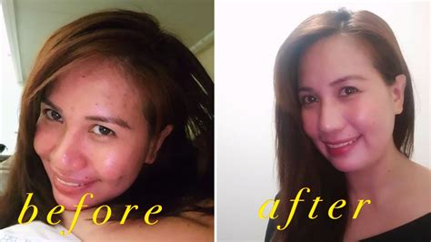 How To Reduce Acne Scarsdiscolorationand Uneven Skin Tone In Just 7days