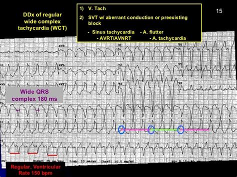 Ekg Module