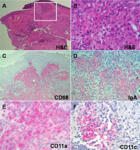 Histology Of Benign Cephalic Histiocytosis With Infiltrates Positive