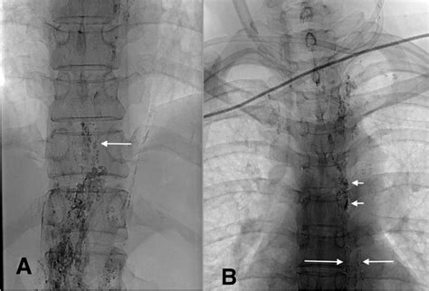 Figure 3 From Percutaneous Sclerosing Injection To The Thoracic Duct