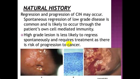 Benign And Malignant Lesions Of The Cervix Youtube