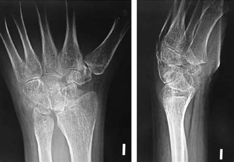 Radiografía Simple Anteroposterior Y Lateral De Muñeca Izquierda Se