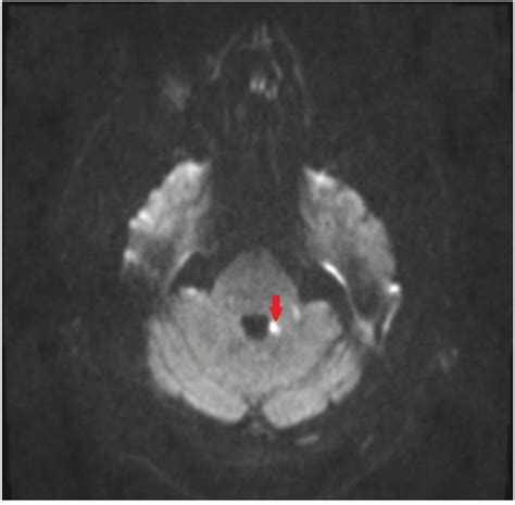 Frontiers Acute Stroke In Middle Cerebellar Peduncle In A Patient