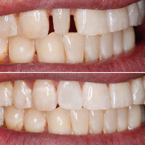 Peg Lateral Fixed With Bonding Orthodontics Cosmetic Dentistry Treats