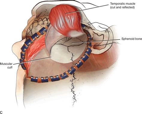 Temporalis Muscle Origin And Insertion