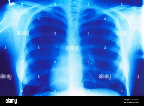 X Ray Of A Human Torso Stock Photo Alamy