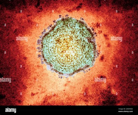 Mumps Virus Particle Coloured Transmission Electron Micrograph Tem