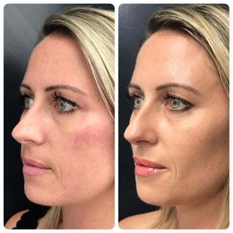 Hollow Cheeks - Laser Skin Care