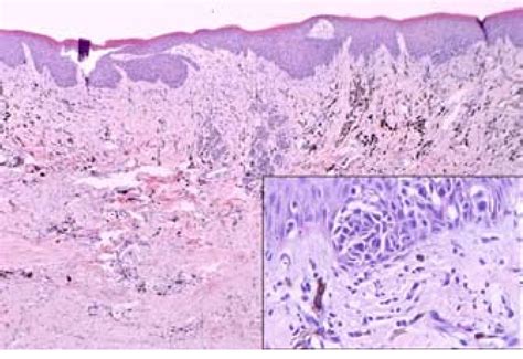 Figure 2 From A Case Of Canine Oral Melanoma With Similar