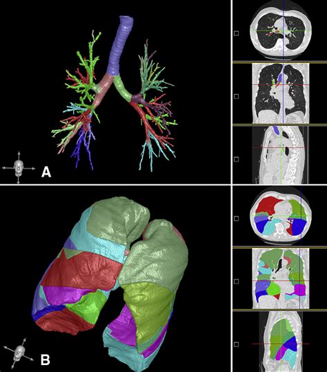 Preoperative 3 Dimensional Computed Tomography Lung Reconstruction