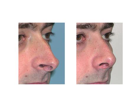 Case Study Rhinoplasty For The Ultra Projecting Nose Explore Plastic