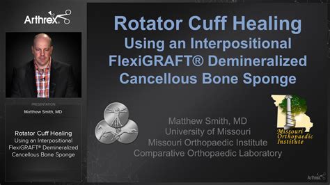 Arthrex Rotator Cuff Healing Using An Interpositional Flexigraft