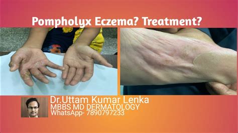What Is Pompholyx Eczema Reason And Treatment Of Itchy Vesicles