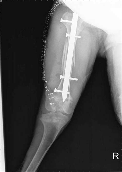 Comminuted Fracture Of The Mid Diaphysis Of The Femur In A 3 Month Old