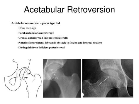 Acetabular Retroversion Mri