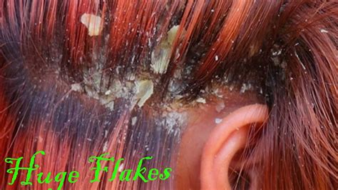 Big Flakes Itchy Psoriasis Scalp Dandruff Combing 56 Youtube