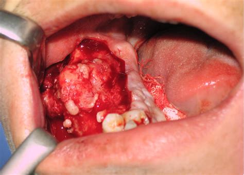 Juvenile Hyaline Fibromatosis Of The Mandible With Bone Involvement