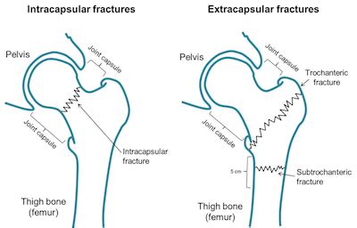 Hip Fracture Surgery | Orthopaedics 360