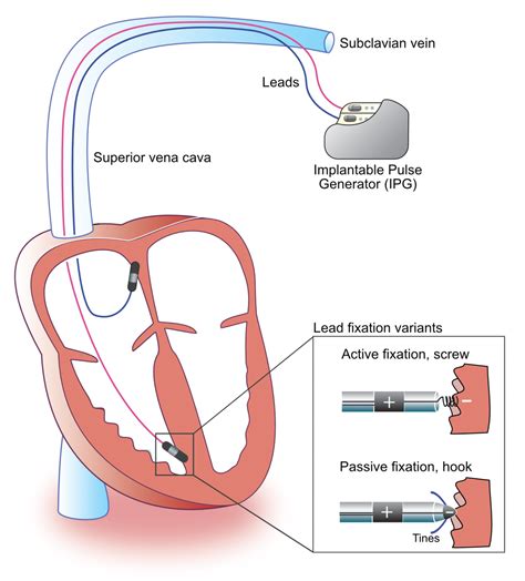 Components And Construction Of A Pacemaker Ecg And Echo