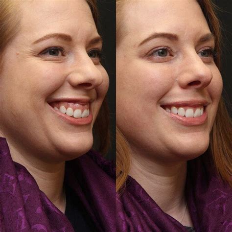 How To Fix A Gummy Smile Without Surgery Crown Lengthening To Raise