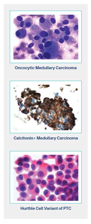 Thyroid Cytology Services Thyroseq®