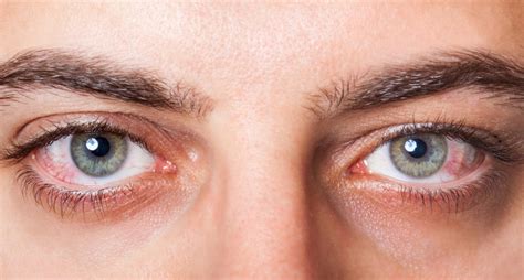Dry Eye Treatment With Blephex Omaha Kugler Vision