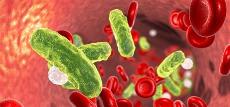 How long does it take sepsis to kill a person? Sepsi (setticemia): cause, sintomi, shock settico e ...